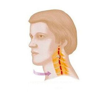 vertebral syndrome nga adunay cervix osteochondrosis
