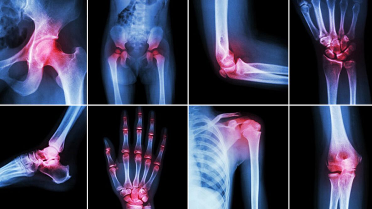 Mga X-ray alang sa sakit sa lutahan