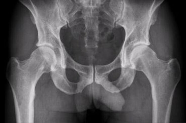 x-ray sa hip joint alang sa kasakit