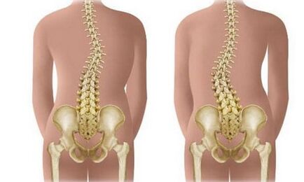 Dili -resant nga scoliosis