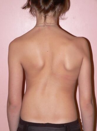 Scoliosis 2 degree