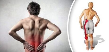 Sakit sa Sakit sa Sakit sa Lumbar Osteochondrosis sa mga Bities