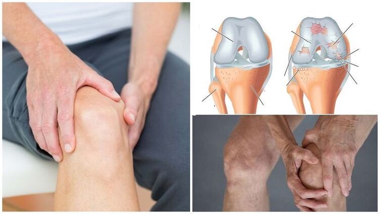 Ang simtomas sa tuhod nga simtomas sa arthrosis sa lutahan sa tuhod
