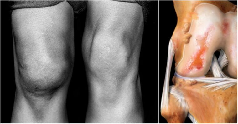 Arthrosis sa lutahan sa tuhod ug sakit nga lutahan