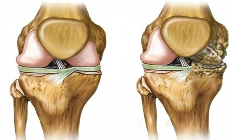 Himsog ug apektado sa arthrosis nga hiniusa