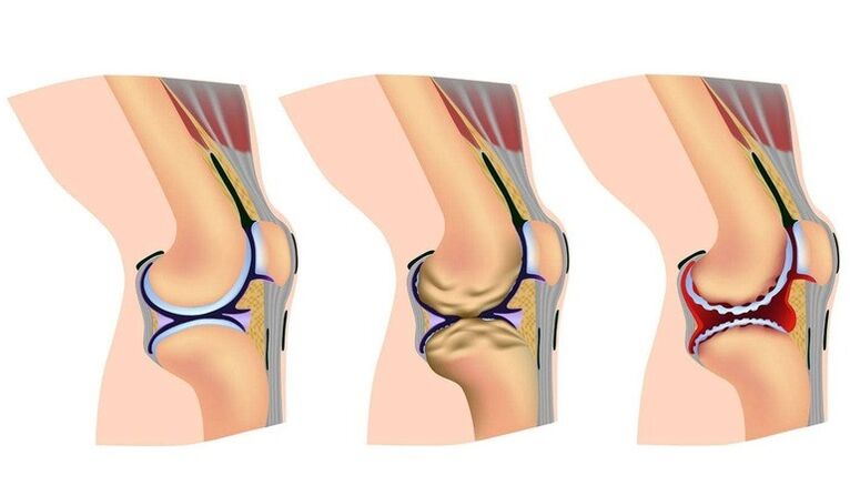 Mga yugto sa pagbag-o sa tuhod nga hiniusa alang sa Arthrosis