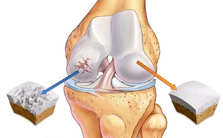 normal nga kartilago ug apektado sa arthrosis