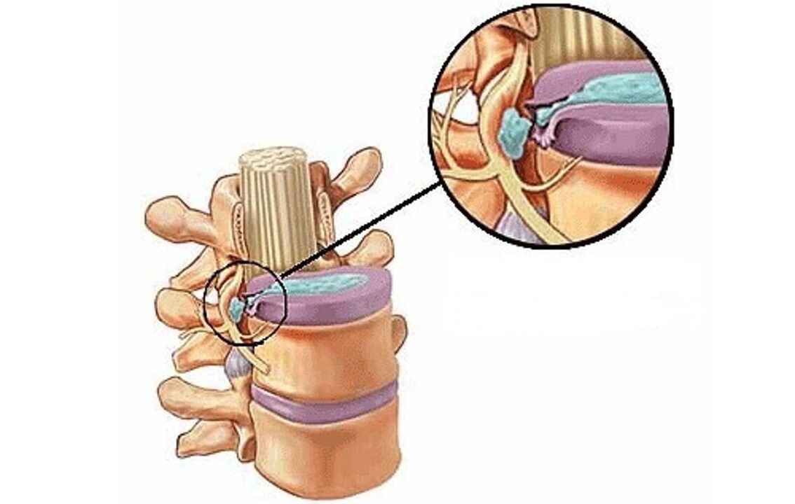 intervertebral hernia uban sa thoracic osteochondrosis