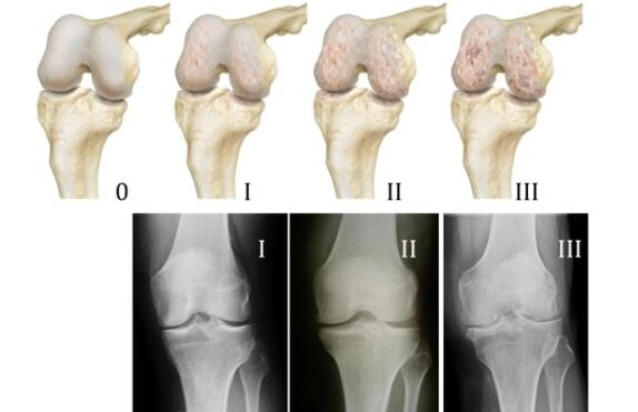 Mga pamaagi alang sa pagdayagnos sa arthrosis sa tuhod