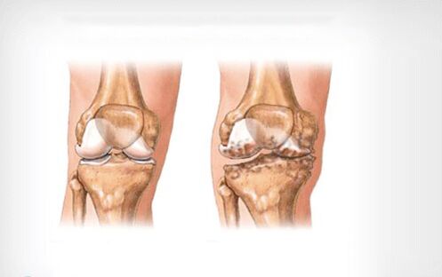 arthrosis sa lutahan sa tuhod