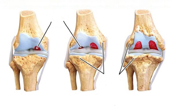 mga yugto sa arthrosis sa tuhod